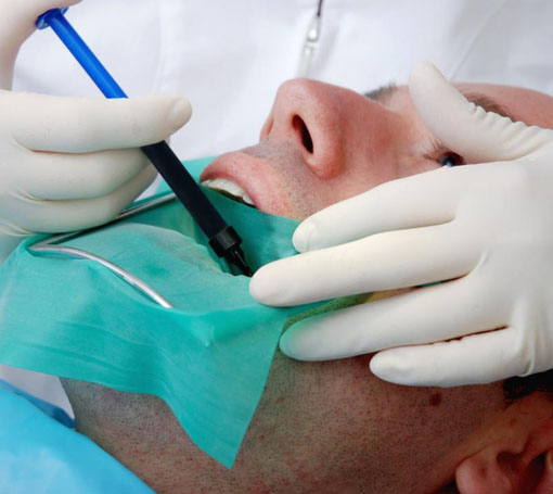 root canal treatment in Vikaspuri